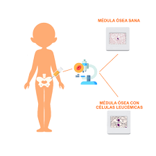 We did not find results for: Leucemia Linfoblastica Aguda Infantil Fundacion Josep Carreras Contra La Leucemia