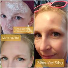 Has anyone used bee stings for anti inflammatory and pain relief? Was it  beneficial? I have a very experienced bee keeper friend who has suggested  it to me.