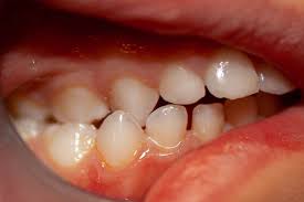 Uberbiss Zahn Und Kieferfehlstellung Ursachen