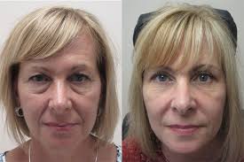 Full Face Blepharoplasty Before And After Photos Eye Bag Surgery Bloated Face Plastic Surgery