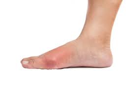 Pictures of gout in feet. Gout Overview