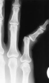 Image result for Interphalangeal Dislocation