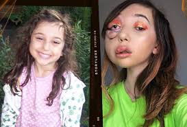 This Inspirational Influencer Is Bravely Conquering Her Rare Disease