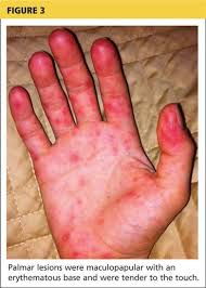 The rash appears as rough, red, or reddish brown spots on the palms of the hands and/or the bottoms of the feet. Woman 32 With Crusty Red Blisters Clinician Reviews