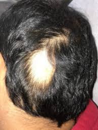 Duke's dermatologists diagnose and treat hair disorders such as hair loss (alopecia), excessive hairiness (hirsutism), and abnormal hair growth (hypertrichosis). Alopecia Areata Treatment Specialist In Philadelphia Main Line Pa Farber Dermatology