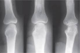 Image result for XRay Changes in Rheumatic Conditions