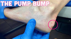 It may be caused by wearing shoes that are too tight or stiff in the surgery can also be used to treat haglund's deformity if less invasive methods don't work. Minimally Invasive Surgery For Haglund S Deformity Upcoming Case Youtube