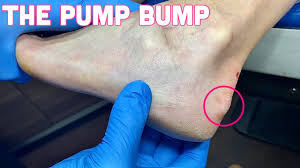 1 an isolated haglund's deformity can lead to posterior heel pain in runners due to adjacent soft traditional radiographic parameters one would use to measure haglund's deformity on plain films. Minimally Invasive Surgery For Haglund S Deformity Upcoming Case Youtube