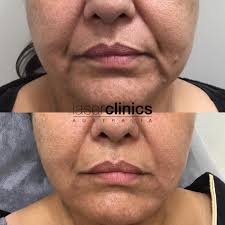 Laser hair removal continues to be a popular choice for permanent hair reduction of unwanted hair, among all genders of all age groups. North Ryde Macquarie Centre Laser Clinics Australia