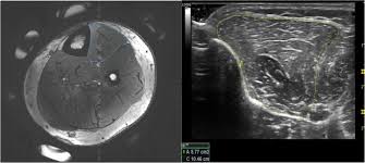 Check spelling or type a new query. Leg Muscle Cross Sectional Area Measured By Ultrasound Is Highly Correlated With Mri Journal Of Foot And Ankle Research Full Text