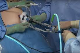 Вранье инвесторам, поломки пк, всеобщий хейт. New Gallbladder Surgery Uses Smallest Reported Incision Upi Com