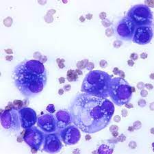 Most often, however, the pleural fluid cytology . Cytology Of Pleural Fluid Clumps Of Neoplastic Cells With Download Scientific Diagram