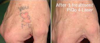 Lux if you have an old tattoo to remove or desire a brighter, fresher appearance, the providers at lux dermatology are ready to help. Laser Tattoo Removal Bakersfield Beautologie