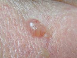 Skin cancer pictures by type. Skin Cancer Nashua Basal Cell Carcinoma New Hampshire Actinic Keratoses