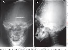 Pathology the defect is not one of pressure from within (in contrast to copper beaten skull appearance of hydrocephalus, or normal convolutional markings) but rather of abnormal collagen development and ossification, since the skull vault ossification process is the membranous ossification. Figure 2 From Crouzons Syndrome A Case Report Semantic Scholar