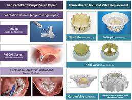 تويتر Heart Bmj على تويتر Transcatheter Tricuspid Intervention Ready For Primetime Https T Co 09jnukoalp Https T Co Fim35yzhsr