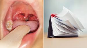 Image result for Tonsillitis