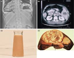 Image result for Liver Abscess