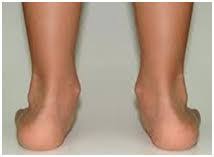 Mi Hijo Mete Los Pies Hacia Dentro Como Corregirlo