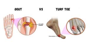 Image result for gout symptoms toe