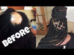 How To Dress Up A Bald Patch Video Grow Black Hair Long Hair Growth Diy Diy Wig