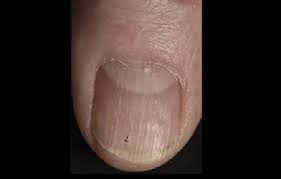 We did not find results for: What Is Nail Psoriasis And How Can I Treat It