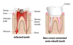 A tooth root infection, if left untreated. In General How Long Will The Tooth Last After Root Canal Adding Filling And Also Covering A Crown Quora