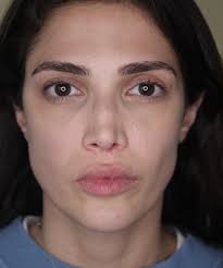 Dr. Milos Kovacevic Nasenkorrektur-Nasennachkorrektur Hamburg  (@dr.miloskovacevic) · Hamburg-Mitte