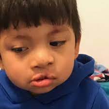 Fundraiser for reynaldo cardona by Caroline Loessin : Cleft lip and palate  repair