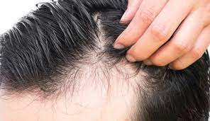 Disebabkan terdapat beberapa jenis keguguran rambut, rawatan keguguran tersebut perlulah sesuai dengan jenis keguguran rambut. Rawat Rambut Gugur Cara Alami Untuk Elak Kepala Botak Sebelum Usia Maskulin