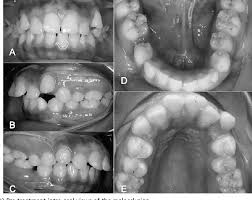 Image result for Gardner Sendromu