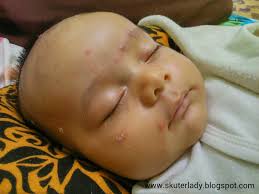 Lentokkan badan sedikit ke hadapan untuk memudahkan sendawa. Skuterlady Baru 3 Bulan Dah Kena Chicken Pox