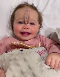 We Got Stares'', Parents Choose to Remove Baby Girl's Rare Birthmark to  Avoid Rude Reactions