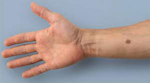 If you experience any difficulty while speaking or chewing food (in addition to the other symptoms) it may be an indication of mouth cancer. Soon Your Skin Will Tell You If You Have Cancer