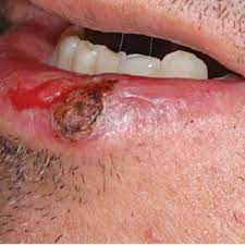 Some people notice only a change to their skin, such as. Squamous Cell Carcinoma Of The Lip Shallow Ulcer With Infiltrated Download Scientific Diagram