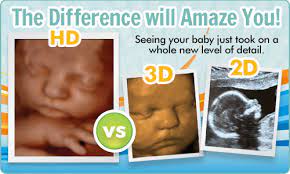 3d Ultrasound 4d Ultrasound Hd Ultrasound Lake Jackson Stork Shots
