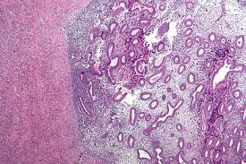 A multicenter study across ten countries. Endometriosis Wikipedia