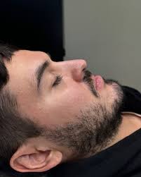 Rinomodelación masculina💉👃🏻 Procedimiento realizado en consultorio, con  la colocación previa de crema anestésica para mayor confort del paciente. A  su vez la jeringa de ácido hialurónico contiene lidocaína, sumando mayor  analgesia, para