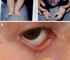 Ocular Manifestations Of Ectodermal Dysplasia Orphanet Journal Of Rare Diseases Full Text