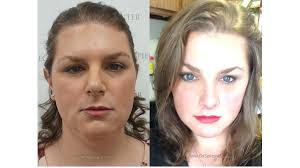Https Www Drspiegel Com Ffs Facial Femininization Surgery In 2020 Facial Feminization Surgery Hair Grafting Facial