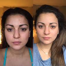 Check spelling or type a new query. B A 1 Month Of Dedicated Skincare Skincareaddiction