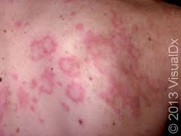 Image result for allergy rash on the legs
