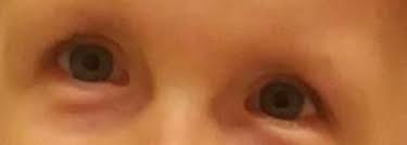 Ocena bólu test berga jeden test na stan. Opadajace Kaciki Oczu Marfan