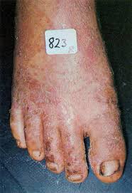 Image result for Tropical Edema