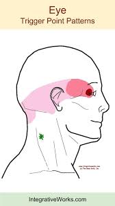 understanding trigger points headache around the brow