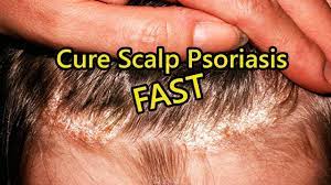 Pin On Psoriasis