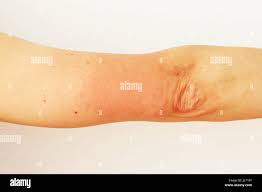 Image result for Photodermatitis