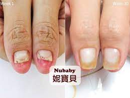 翹甲矯正挽救他店不當處理的飛甲 妮寶貝指甲 nails beauty