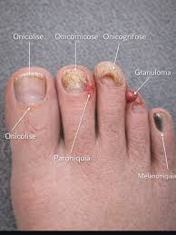 Image result for flegmona pedis)