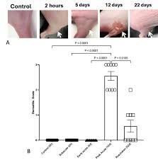 Image result for Radiation Dermatitis